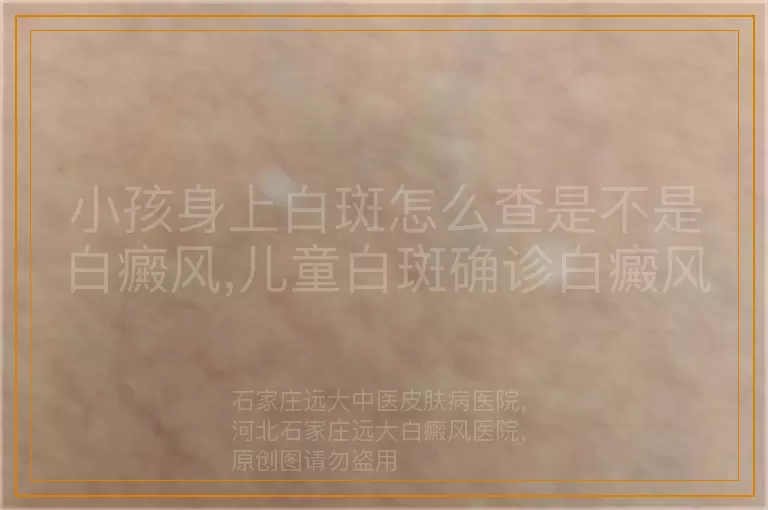 小孩身上白斑怎么查是不是白癜风,儿童白斑确诊白癜风哪种检查方法准,孩子白斑怀疑白癜风如何准确判断