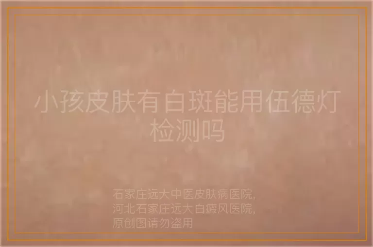 小孩皮肤有白斑能用伍德灯检测吗