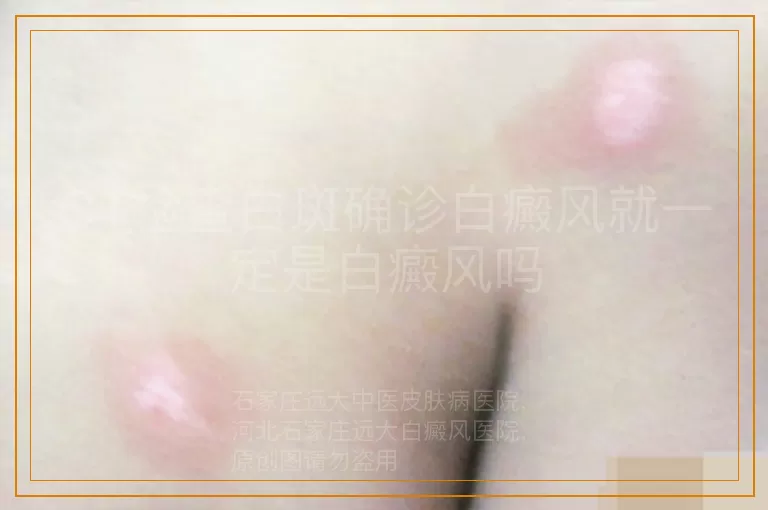 CT检查白斑确诊白癜风就一定是白癜风吗