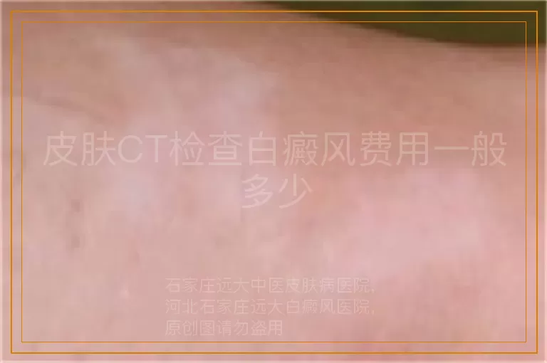 皮肤CT检查白癜风费用一般多少