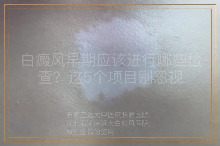 白癜风早期应该进行哪些检查？这5个项目别忽视