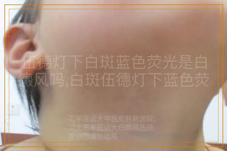 伍德灯下白斑蓝色荧光是白癜风吗,白斑伍德灯下蓝色荧光是白癜风吗,伍德灯查白斑蓝色荧光是白癜风吗