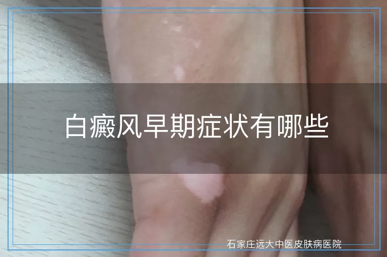 白癜风早期症状有哪些