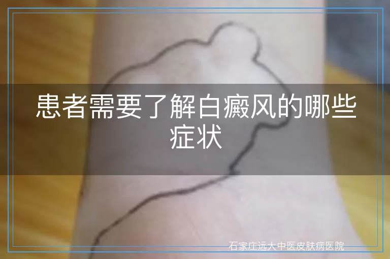 患者需要了解白癜风的哪些症状
