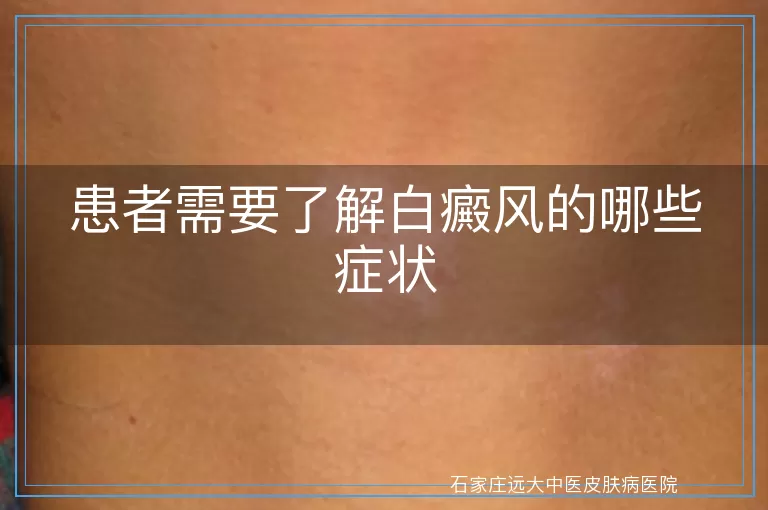 患者需要了解白癜风的哪些症状