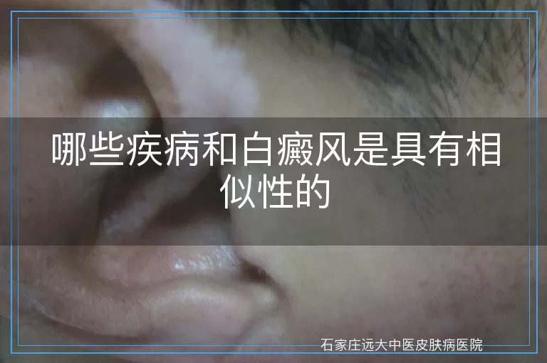 哪些疾病和白癜风是具有相似性的