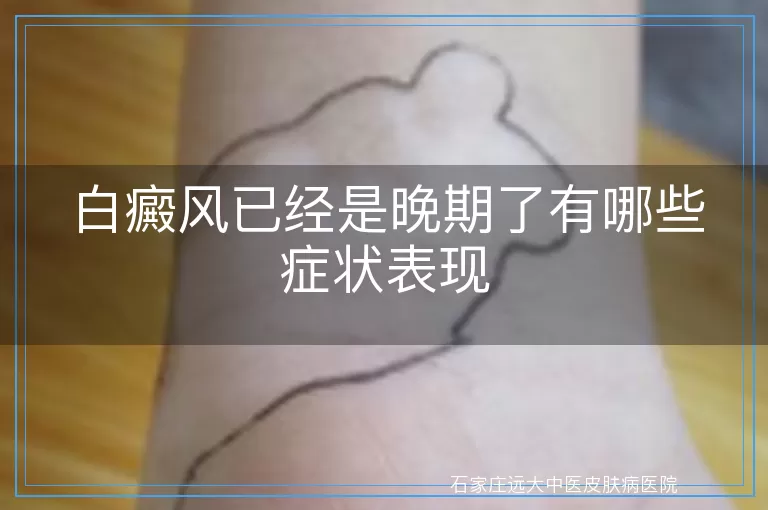 白癜风已经是晚期了有哪些症状表现