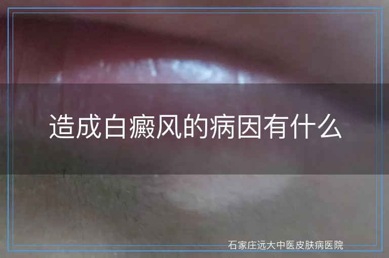 造成白癜风的病因有什么