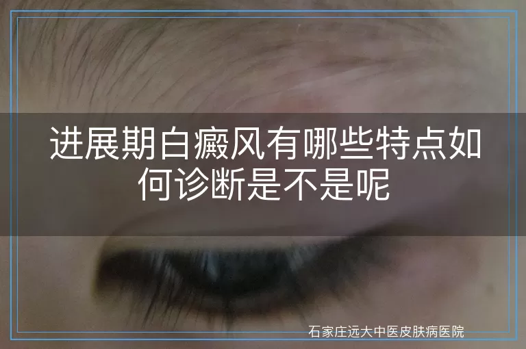 进展期白癜风有哪些特点如何诊断是不是呢