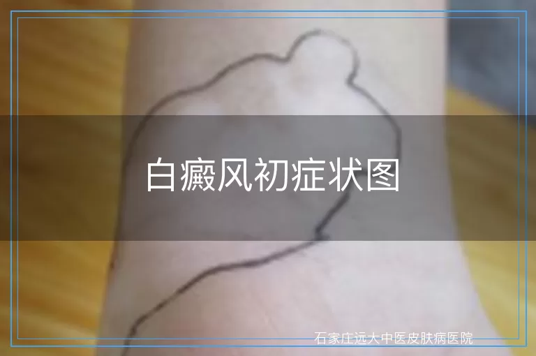 白癜风初症状图