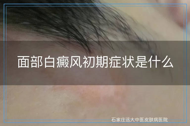 面部白癜风初期症状是什么