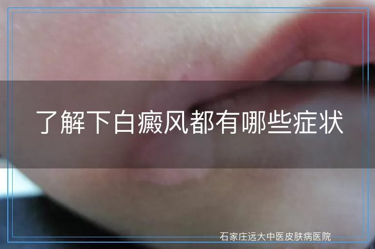 了解下白癜风都有哪些症状