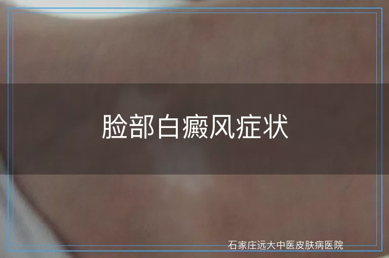 脸部白癜风症状