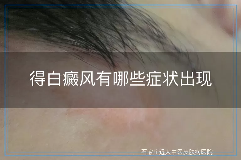 得白癜风有哪些症状出现