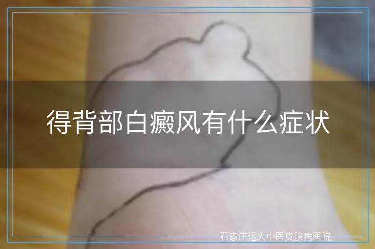 得背部白癜风有什么症状