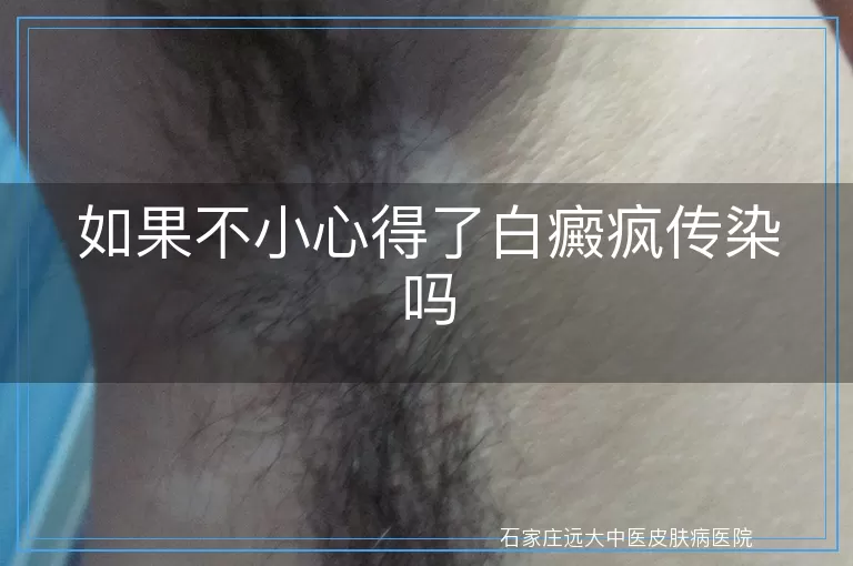 如果不小心得了白癜疯传染吗