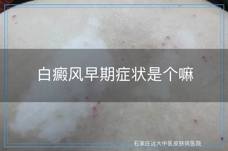白癜风早期症状是个嘛
