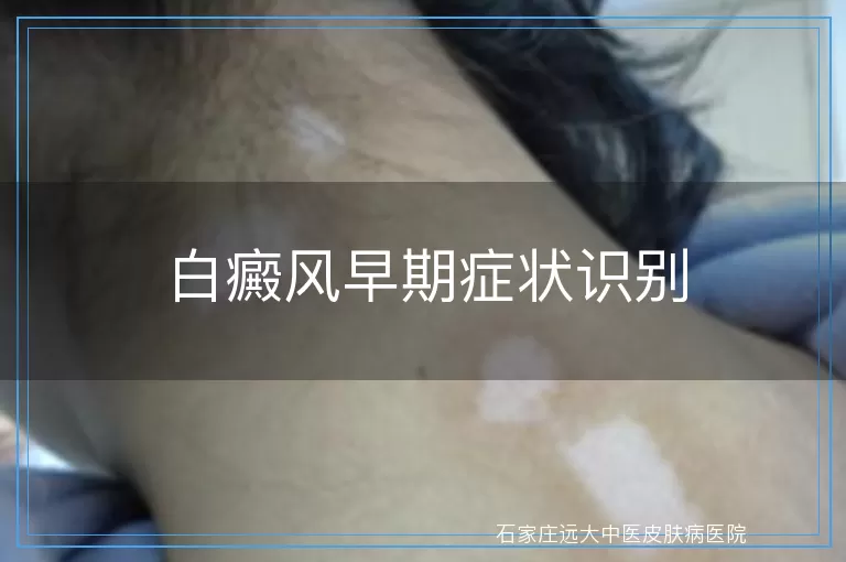 白癜风早期症状识别