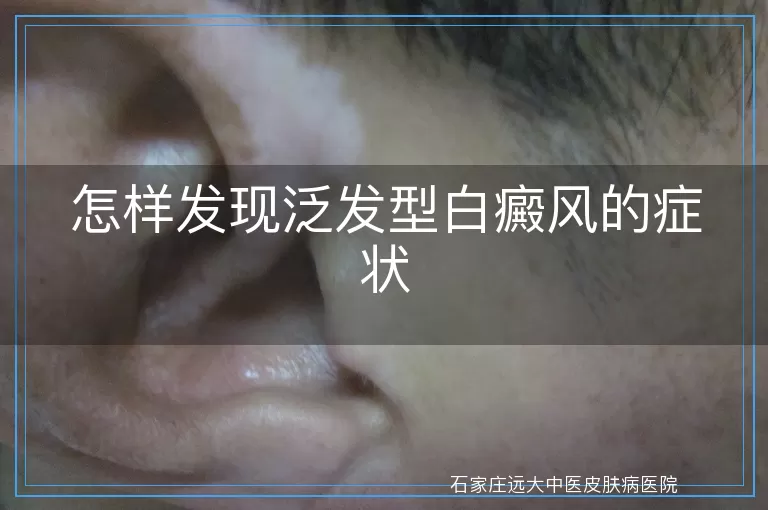 怎样发现泛发型白癜风的症状