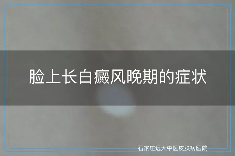 脸上长白癜风晚期的症状