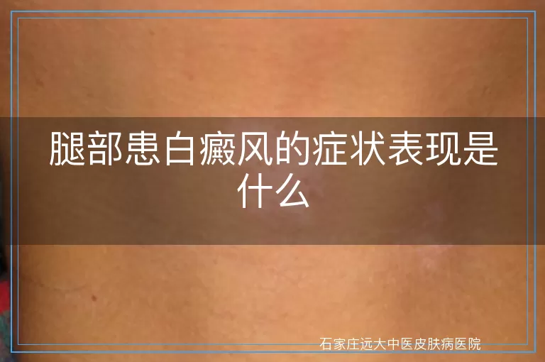 腿部患白癜风的症状表现是什么