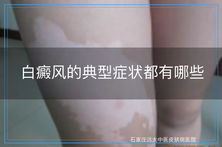白癜风的典型症状都有哪些