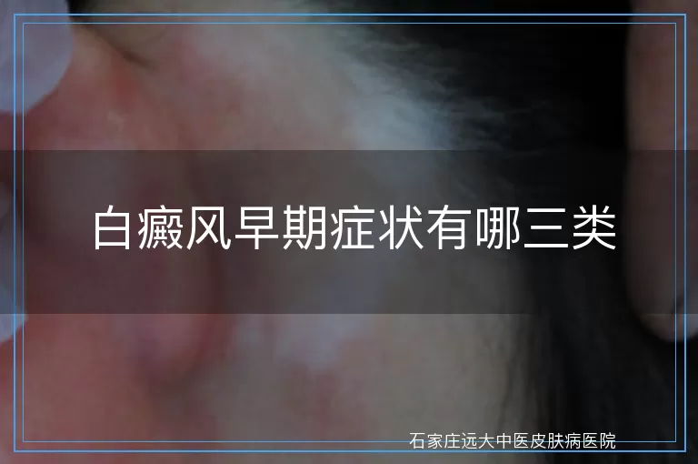 白癜风早期症状有哪三类
