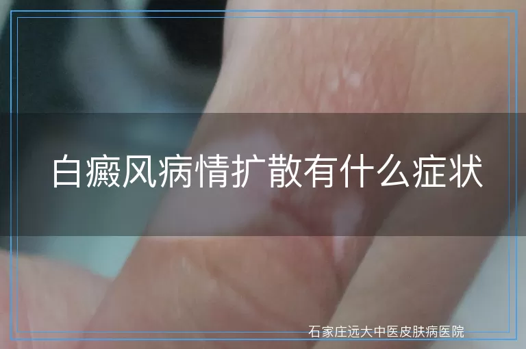 白癜风病情扩散有什么症状