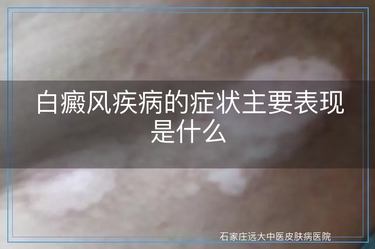 白癜风疾病的症状主要表现是什么