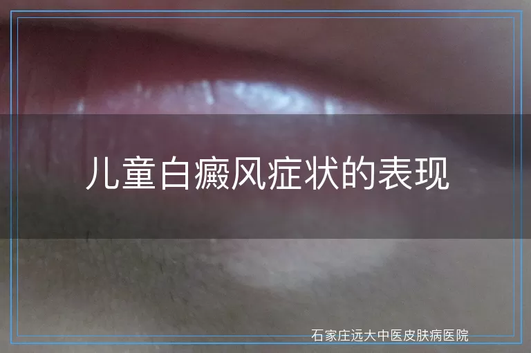 儿童白癜风症状的表现