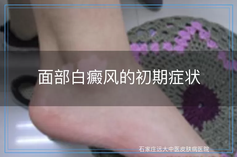 面部白癜风的初期症状