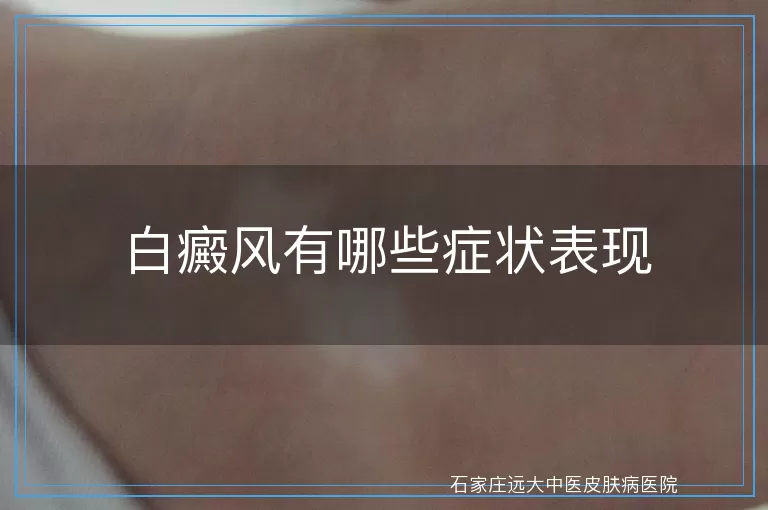 白癜风有哪些症状表现