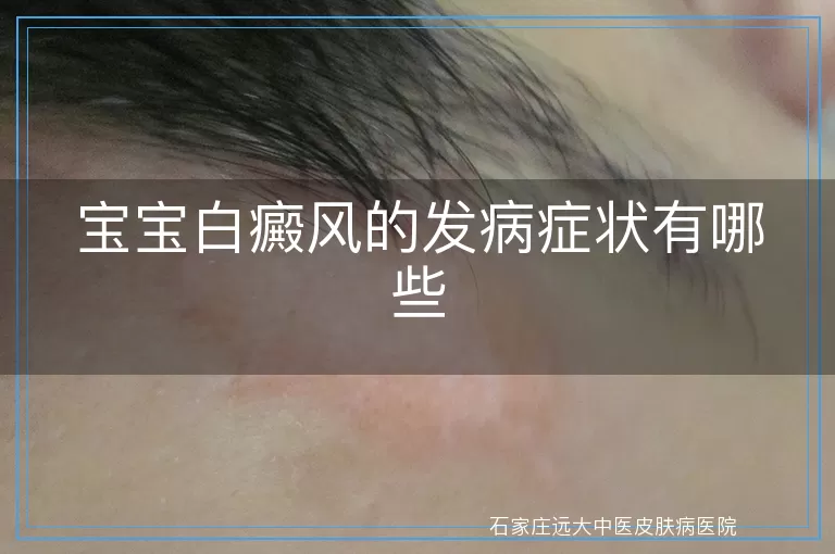 宝宝白癜风的发病症状有哪些