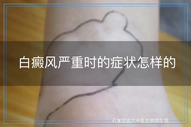 白癜风严重时的症状怎样的