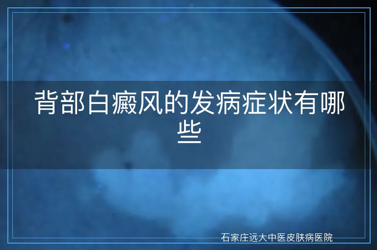 背部白癜风的发病症状有哪些