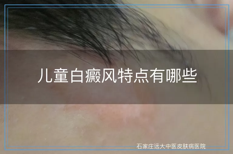儿童白癜风特点有哪些