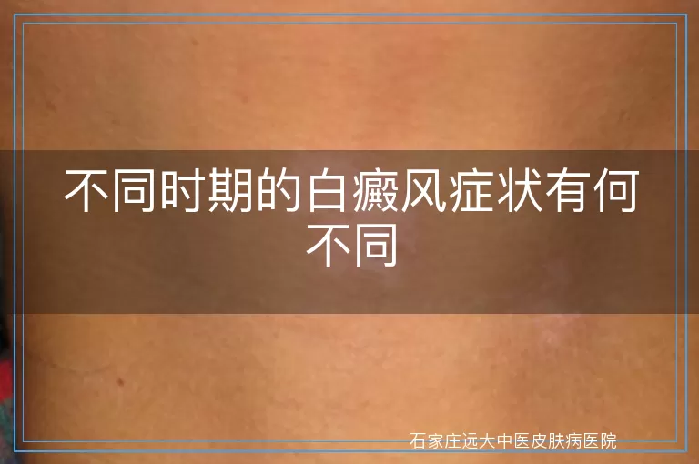 不同时期的白癜风症状有何不同