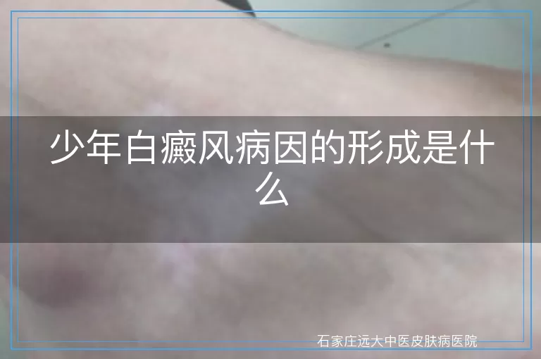 少年白癜风病因的形成是什么