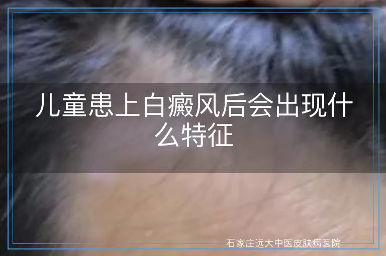 儿童患上白癜风后会出现什么特征