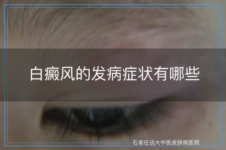 白癜风的发病症状有哪些