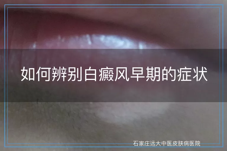 如何辨别白癜风早期的症状