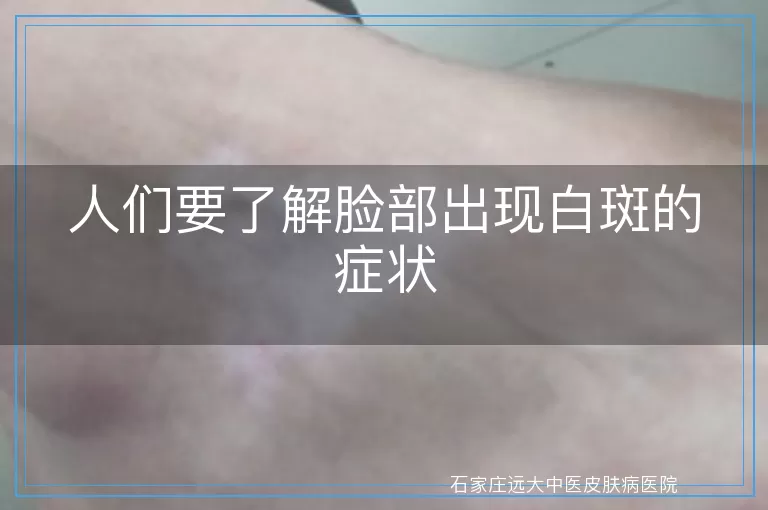 人们要了解脸部出现白斑的症状