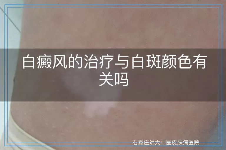 白癜风的治疗与白斑颜色有关吗