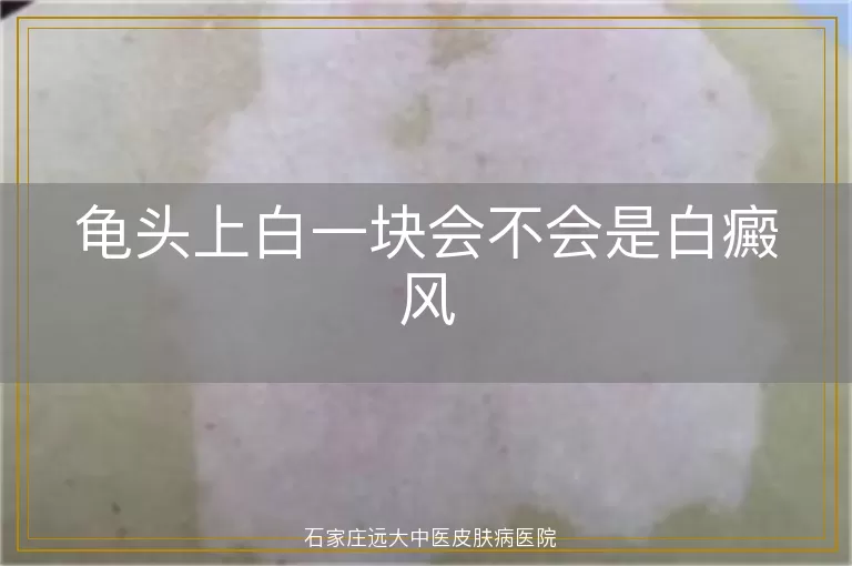 龟头上白一块会不会是白癜风