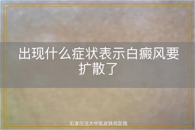 出现什么症状表示白癜风要扩散了