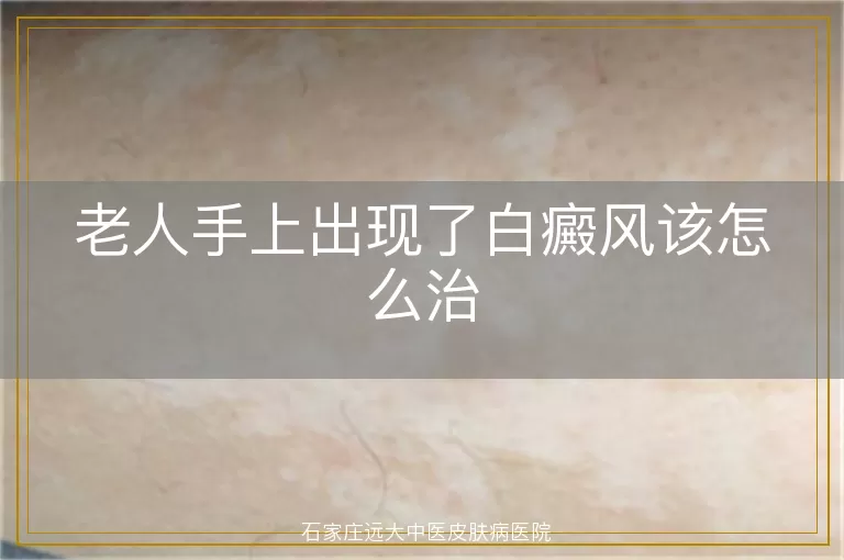老人手上出现了白癜风该怎么治