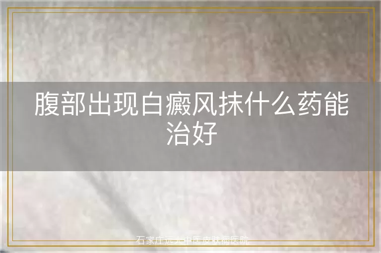 腹部出现白癜风抹什么药能治好