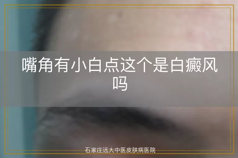 嘴角有小白点这个是白癜风吗