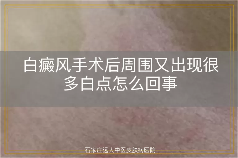 白癜风手术后周围又出现很多白点怎么回事