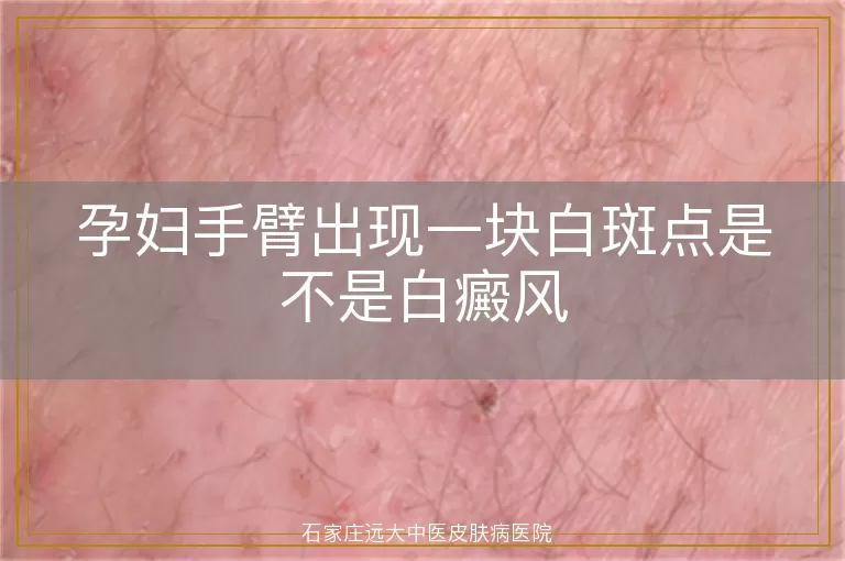 孕妇手臂出现一块白斑点是不是白癜风